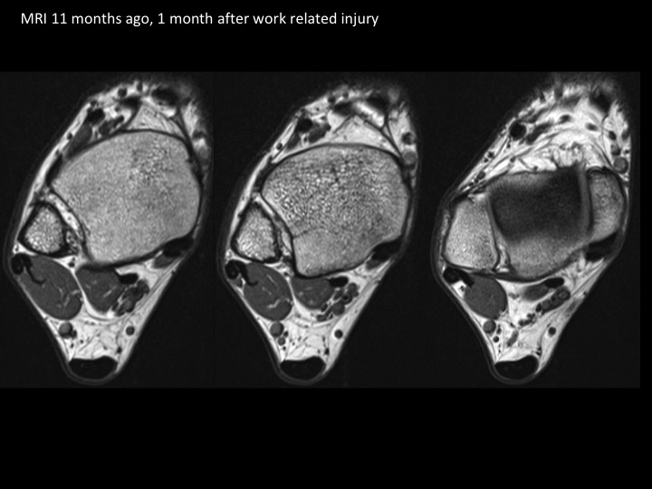 Figure 5 for case flexor retinaculum ( RID2313 )
